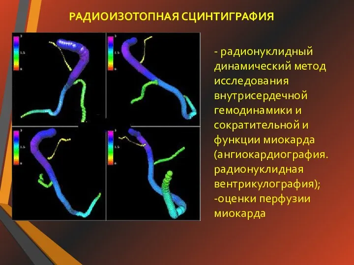 РАДИОИЗОТОПНАЯ СЦИНТИГРАФИЯ - радионуклидный динамический метод исследования внутрисердечной гемодинамики и