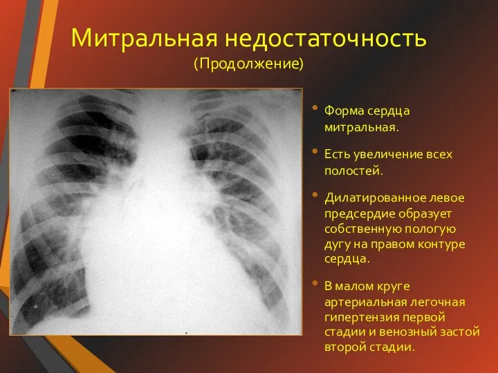 Митральная недостаточность (Продолжение) Форма сердца митральная. Есть увеличение всех полостей.