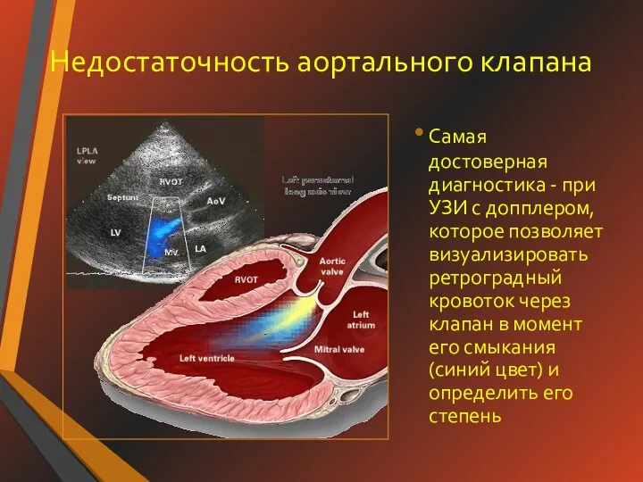 Недостаточность аортального клапана Самая достоверная диагностика - при УЗИ с