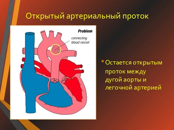 Открытый артериальный проток Остается открытым проток между дугой аорты и легочной артерией