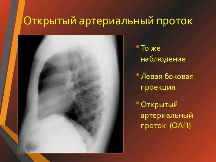 Открытый артериальный проток То же наблюдение Левая боковая проекция Открытый артериальный проток (ОАП)