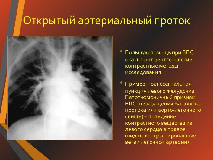 Открытый артериальный проток Большую помощь при ВПС оказывают рентгеновские контрастные