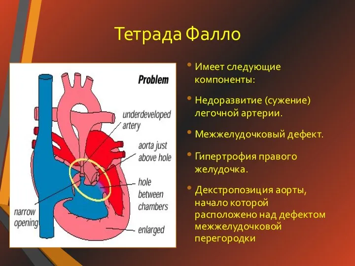 Тетрада Фалло Имеет следующие компоненты: Недоразвитие (сужение) легочной артерии. Межжелудочковый