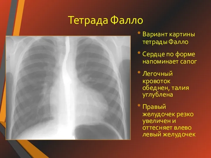 Тетрада Фалло Вариант картины тетрады Фалло Сердце по форме напоминает