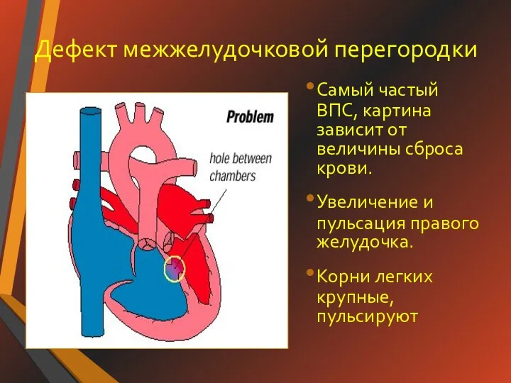 Дефект межжелудочковой перегородки Самый частый ВПС, картина зависит от величины