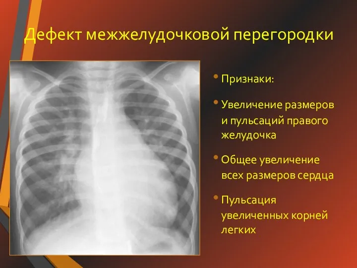 Дефект межжелудочковой перегородки Признаки: Увеличение размеров и пульсаций правого желудочка