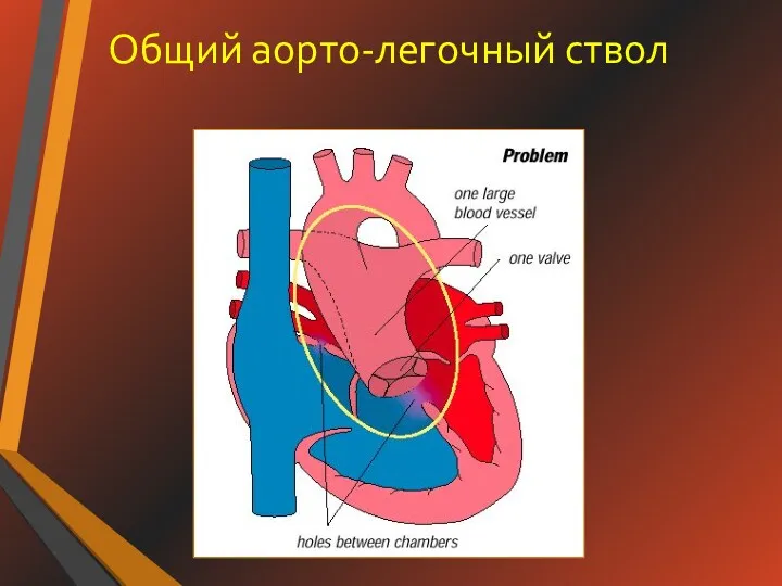 Общий аорто-легочный ствол