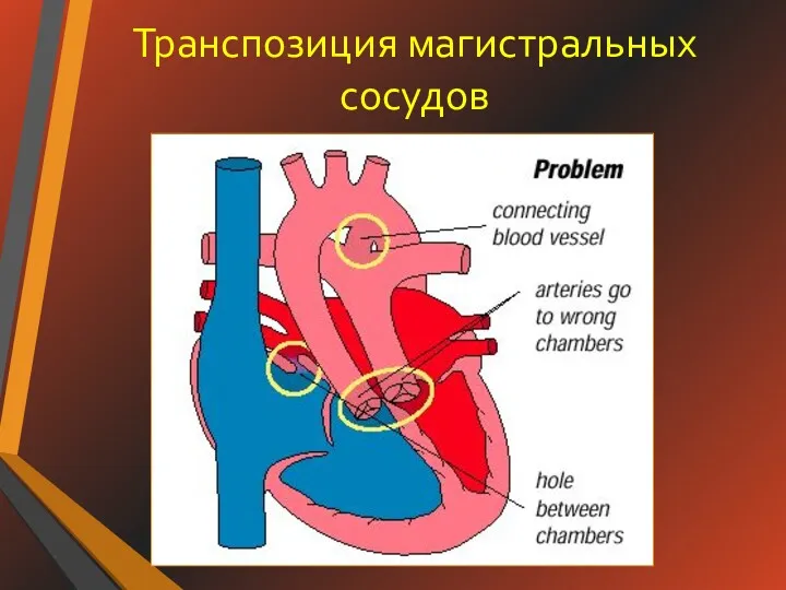 Транспозиция магистральных сосудов