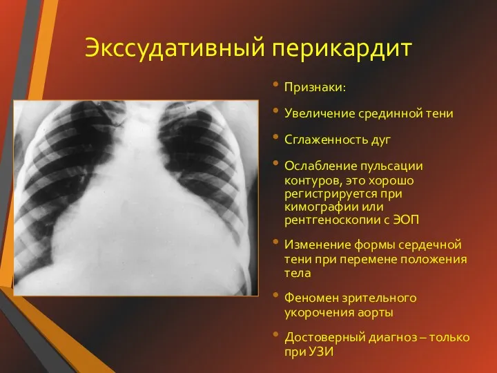 Экссудативный перикардит Признаки: Увеличение срединной тени Сглаженность дуг Ослабление пульсации