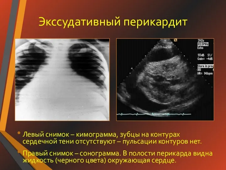 Экссудативный перикардит Левый снимок – кимограмма, зубцы на контурах сердечной