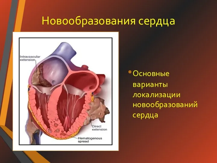 Новообразования сердца Основные варианты локализации новообразований сердца