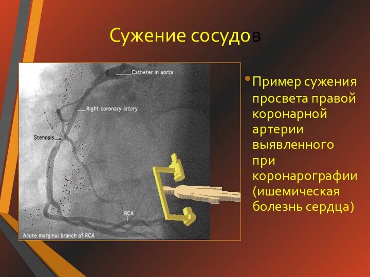 Сужение сосудов Пример сужения просвета правой коронарной артерии выявленного при коронарографии (ишемическая болезнь сердца)