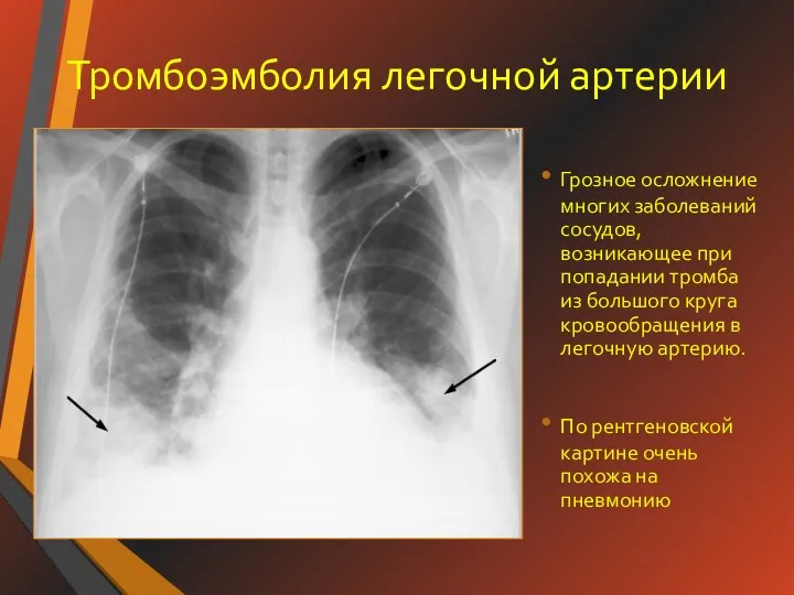 Тромбоэмболия легочной артерии Грозное осложнение многих заболеваний сосудов, возникающее при