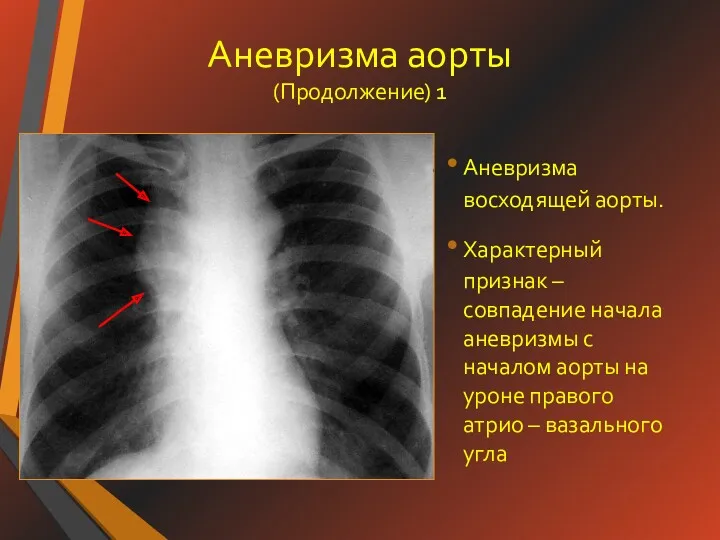 Аневризма аорты (Продолжение) 1 Аневризма восходящей аорты. Характерный признак –