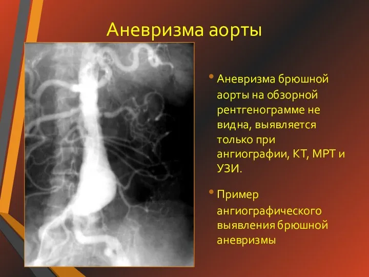 Аневризма аорты Аневризма брюшной аорты на обзорной рентгенограмме не видна,
