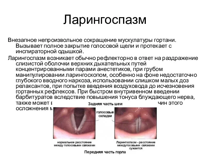 Ларингоспазм Внезапное непроизвольное сокращение мускулатуры гортани. Вызывает полное закрытие голосовой