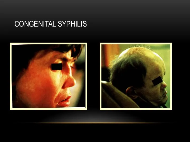 CONGENITAL SYPHILIS