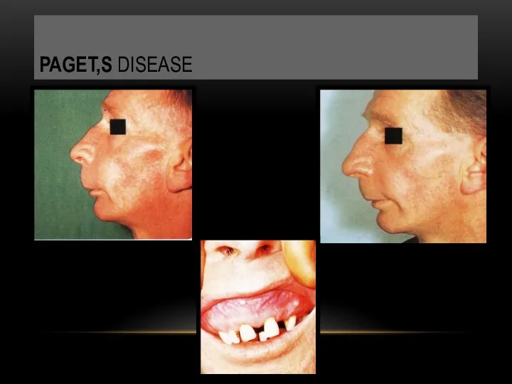PAGET,S DISEASE