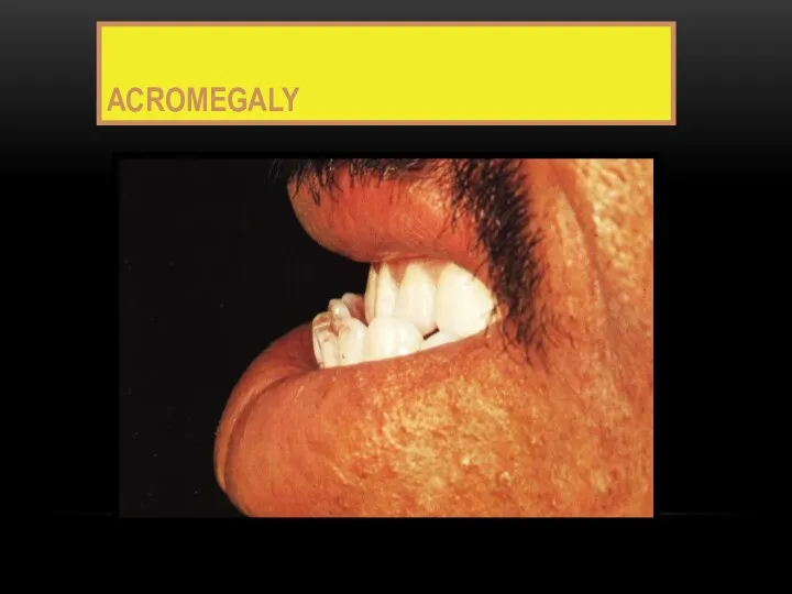 ACROMEGALY