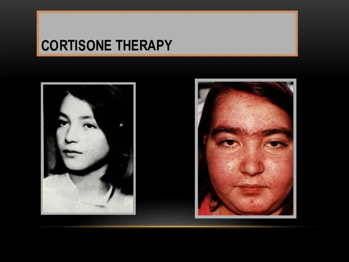 CORTISONE THERAPY