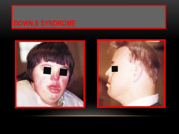 DOWN,S SYNDROME