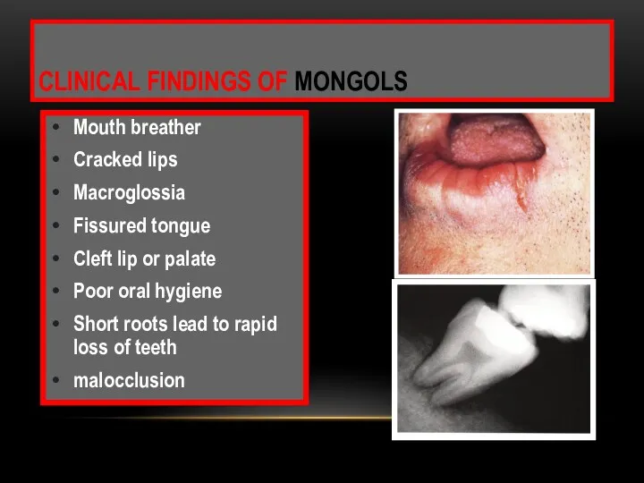 Mouth breather Cracked lips Macroglossia Fissured tongue Cleft lip or