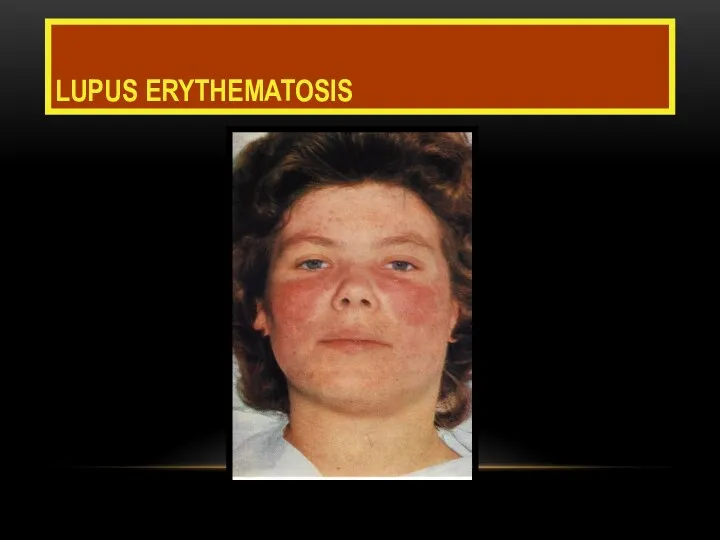 LUPUS ERYTHEMATOSIS