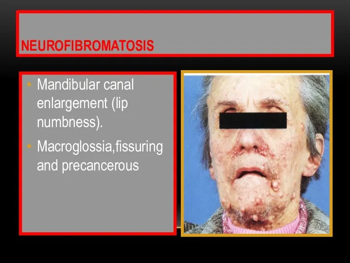 Mandibular canal enlargement (lip numbness). Macroglossia,fissuring and precancerous NEUROFIBROMATOSIS