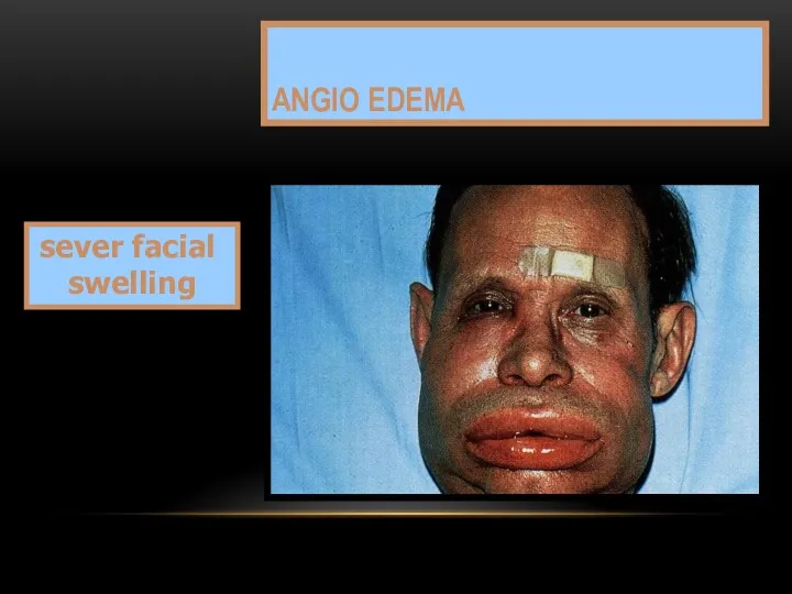 ANGIO EDEMA sever facial swelling