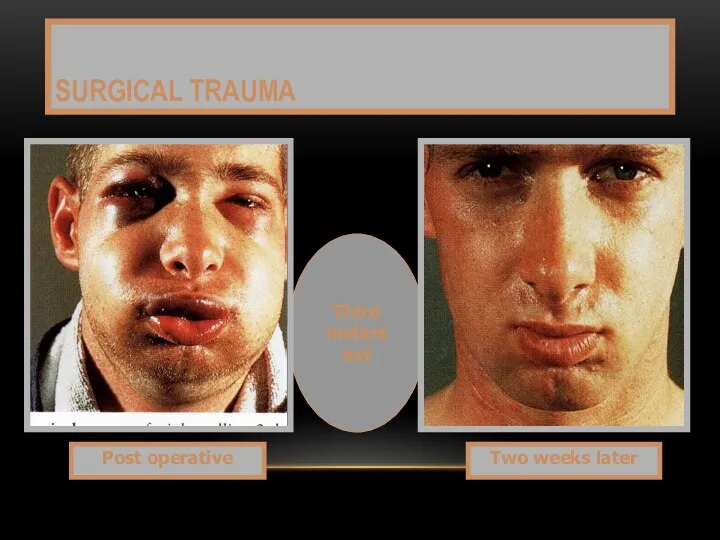 Third molars ext SURGICAL TRAUMA Post operative Two weeks later