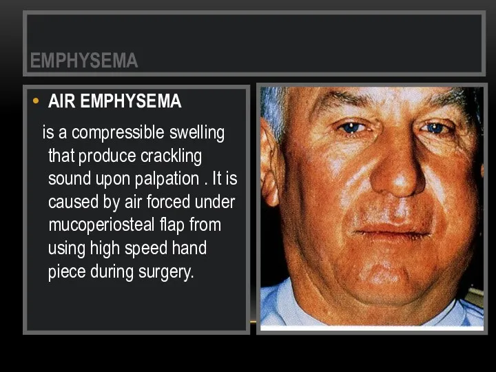 AIR EMPHYSEMA is a compressible swelling that produce crackling sound