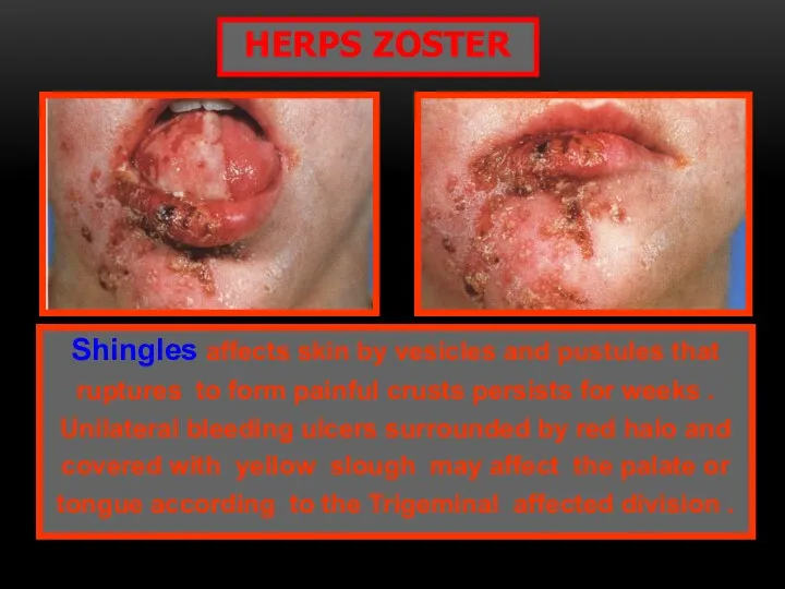 Shingles affects skin by vesicles and pustules that ruptures to