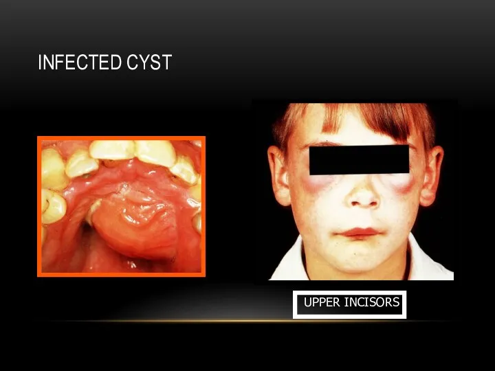 INFECTED CYST UPPER INCISORS