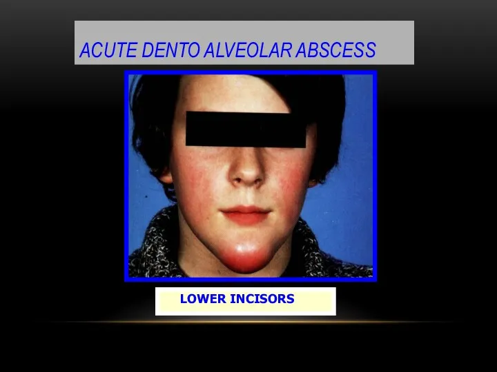 ACUTE DENTO ALVEOLAR ABSCESS LOWER INCISORS