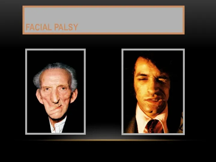 FACIAL PALSY