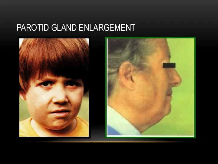 PAROTID GLAND ENLARGEMENT