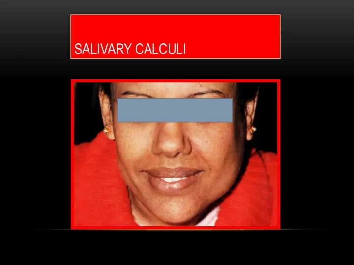 SALIVARY CALCULI