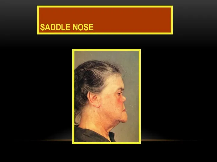 SADDLE NOSE