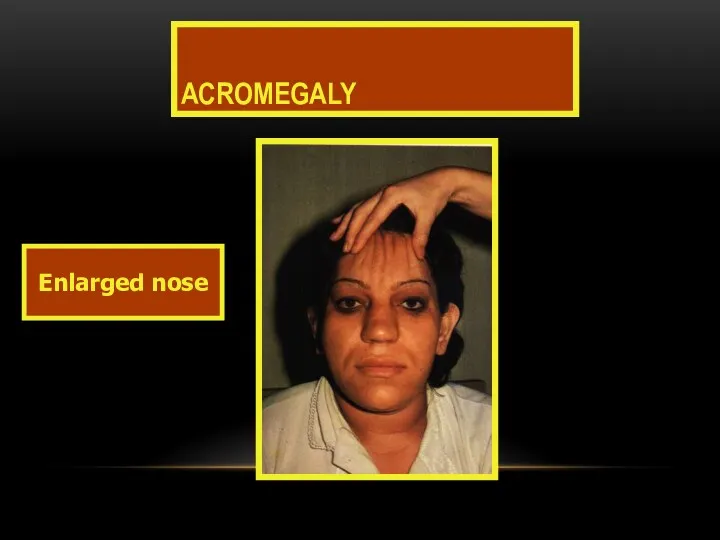 ACROMEGALY Enlarged nose