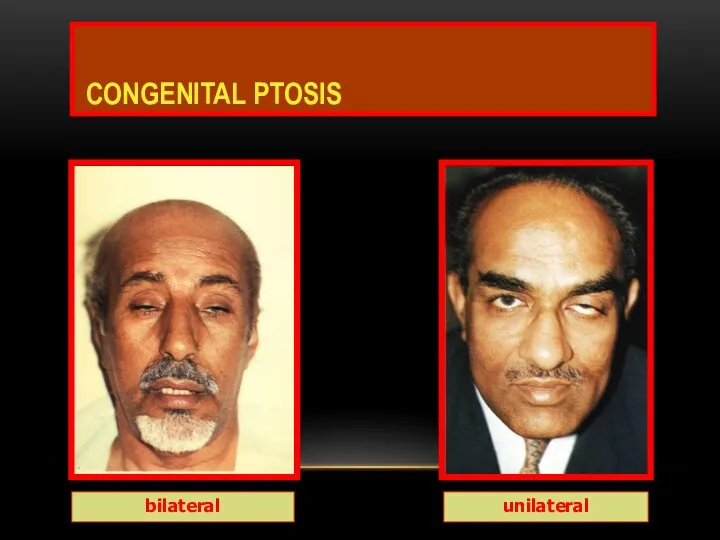 CONGENITAL PTOSIS bilateral unilateral