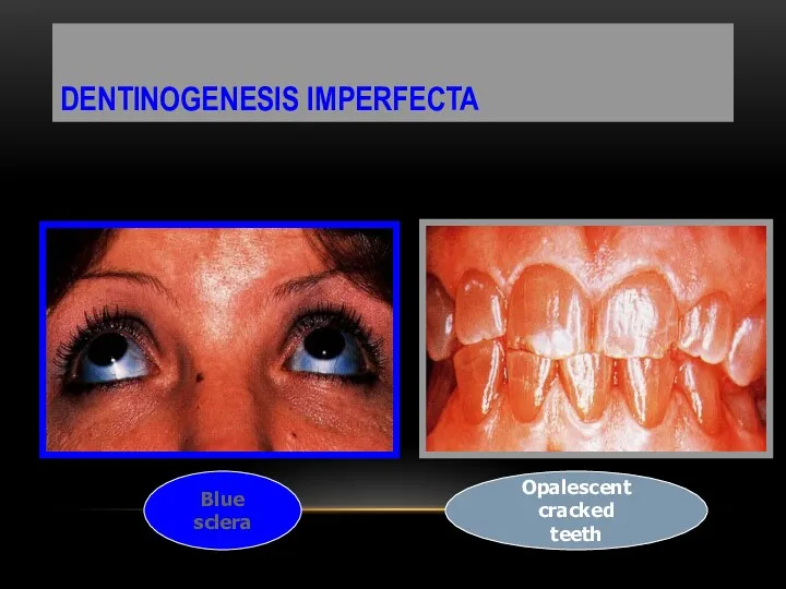 DENTINOGENESIS IMPERFECTA Blue sclera Opalescent cracked teeth