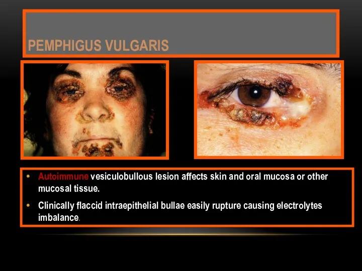 Autoimmune vesiculobullous lesion affects skin and oral mucosa or other