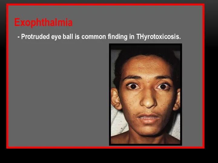 Exophthalmia - Protruded eye ball is common finding in THyrotoxicosis.