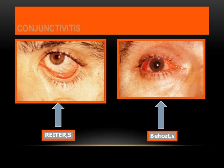 CONJUNCTIVITIS Behcet,s REITER,S