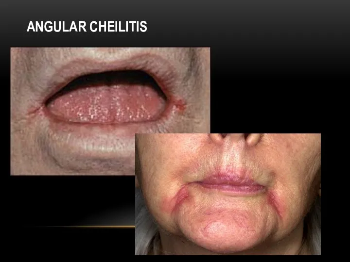 ANGULAR CHEILITIS