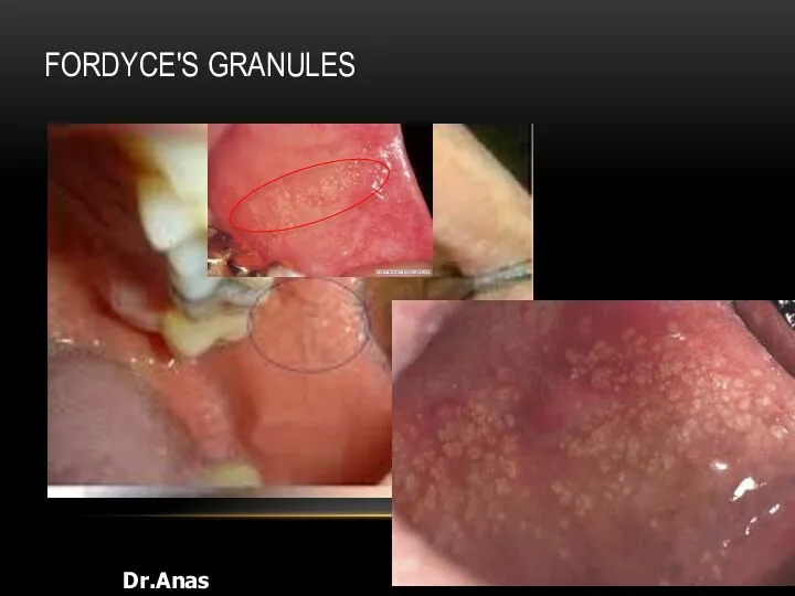 FORDYCE'S GRANULES Dr.Anas Almisurati