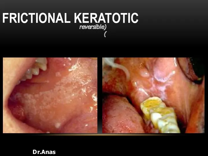 FRICTIONAL KERATOTIC Dr.Anas Almisurati (reversible)