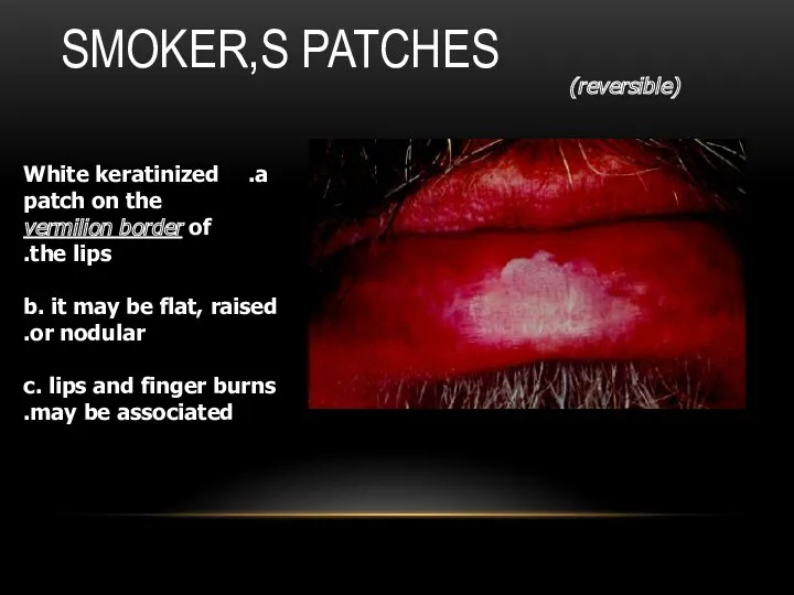 SMOKER,S PATCHES (reversible) White keratinized patch on the vermilion border