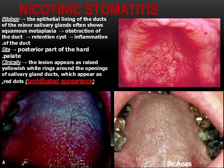 NICOTINIC STOMATITIS Dr.Anas Almisurati Etiology → the epithelial lining of