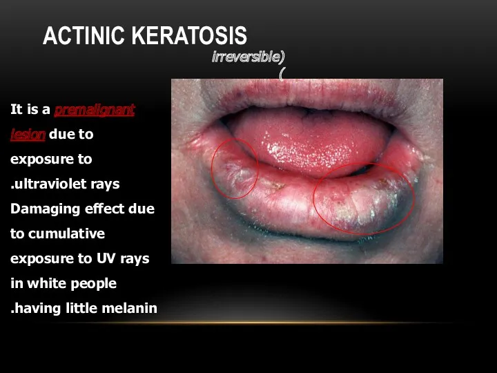 ACTINIC KERATOSIS (irreversible) It is a premalignant lesion due to